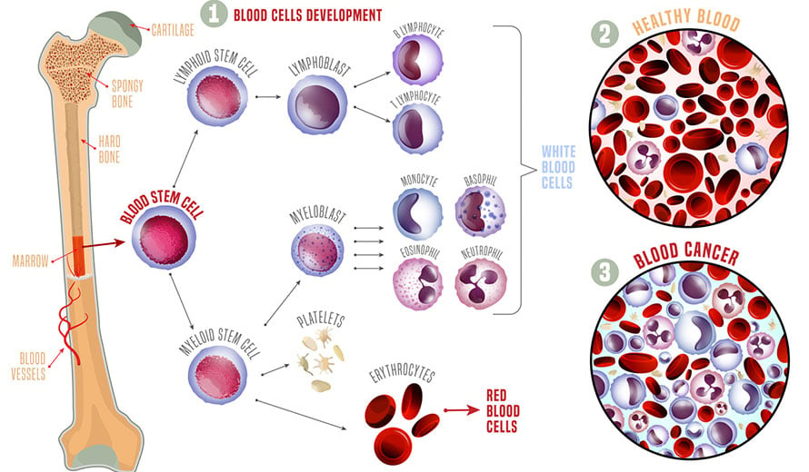 Blood Bone Marrow Transplant BMT Moffitt